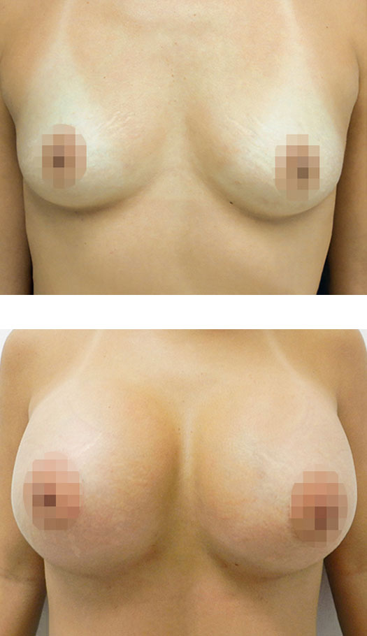 transumbilical breast augmentation before and after case 1