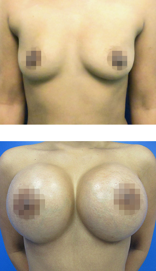 transumbilical breast augmentation before and after case 2