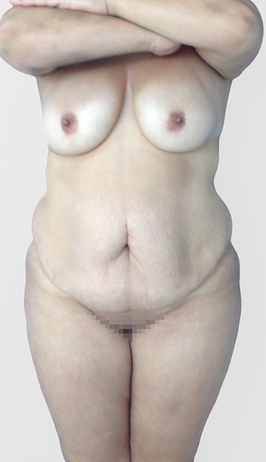 tummy tuck by dr golio 3189 before
